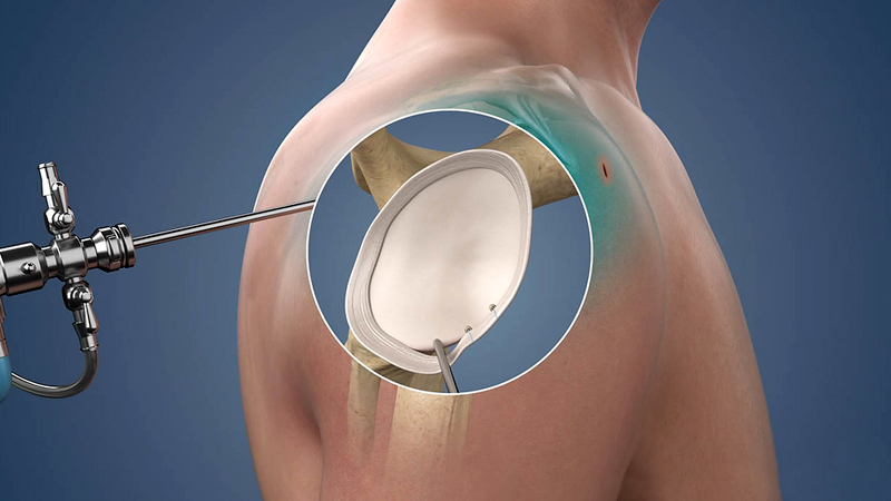 Arthroscopic Bankart Repair