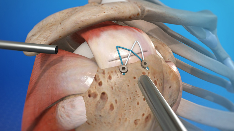 Arthroscopic Cuff Repair