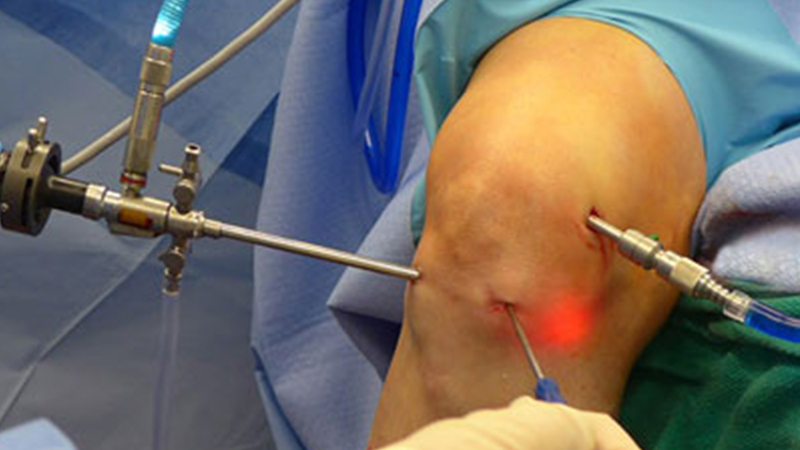 Arthroscopic Meniscus Repair
