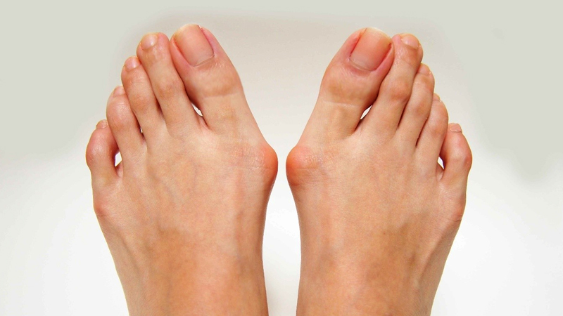 Bunions