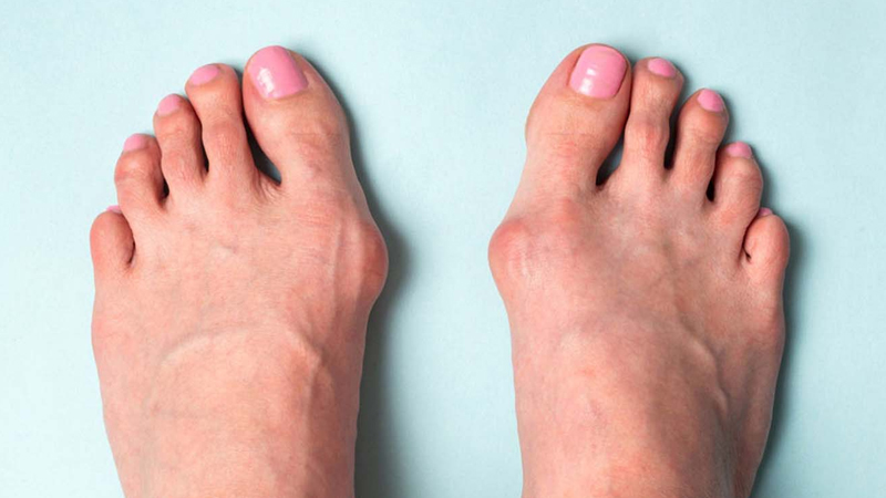Hallux Valgus Correction