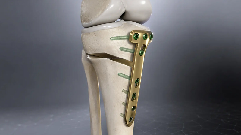 HTO for Knee Preservation