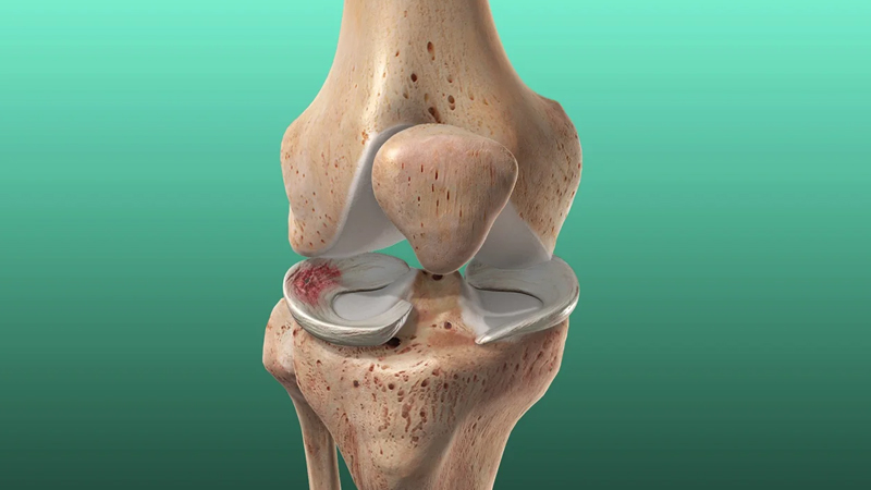 Meniscus Tear