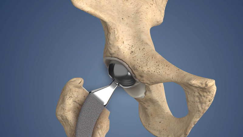 Revision Joint Replacement