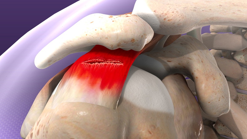 Rotator Cuff Tear