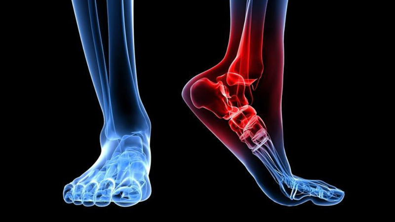 Tendo Achilles Repair